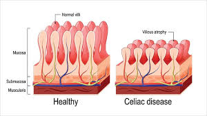 Ảnh 4 của Celiac (Tiêu chảy phân mỡ)
